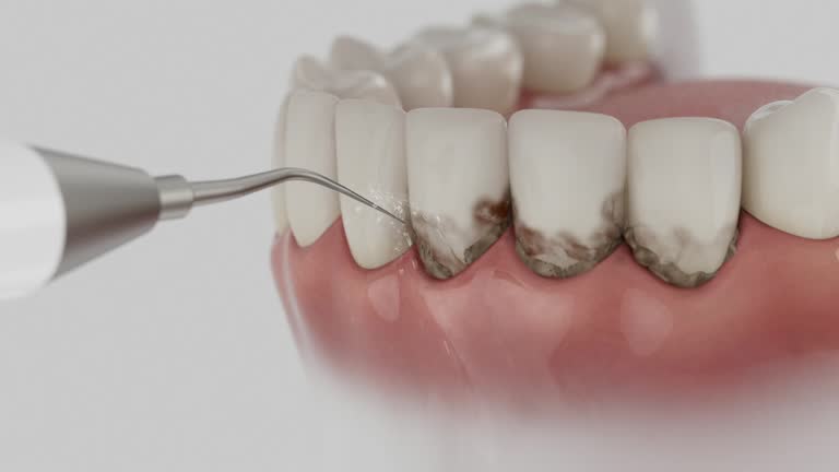 Trusted Wisdom Tooth Removal service in Paynesville, MN - Dentist Open Now